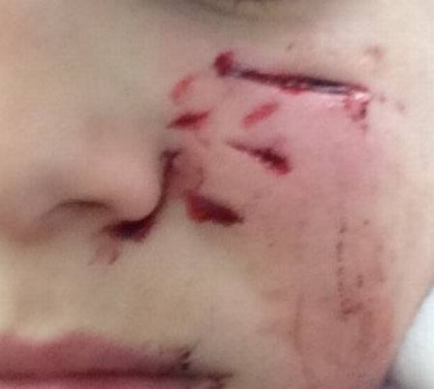Cicatrizes profundas no rosto do menino após ataque. Foto: Reprodução  